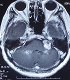 聴神経鞘腫に対するガンマナイフ治療